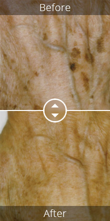 Callula Clinical Treatments - Pigmentation Treatments