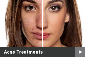 Acne Treatments