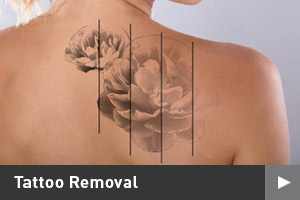 Tattoo Removal